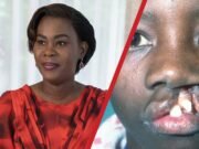 Gabon : Zita Oligui Nguema lance une vaste opération gratuite pour soigner les enfants atteints de « becs de lièvre »