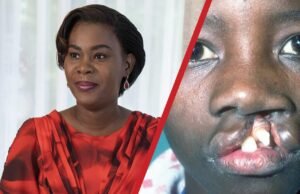 Gabon : Zita Oligui Nguema lance une vaste opération gratuite pour soigner les enfants atteints de « becs de lièvre »