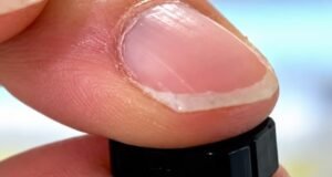 Contraception masculine : un implant sans hormones, potentiellement réversible, pourrait changer la donne d’ici 2033
